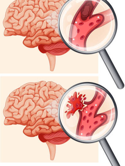 Human Brain and Hemorrhagic Stroke illustration