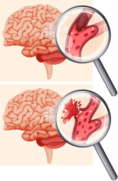Human Brain and Hemorrhagic Stroke illustration