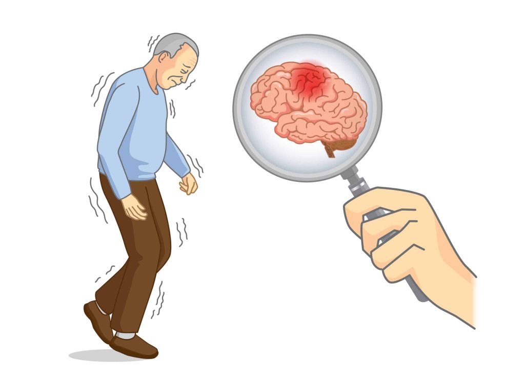 Atypical Parkinsonism Syndrome Refers To Any Conditions That Involve The Types Of Movement Problems Seen In Parkinsons Disease. Scaled