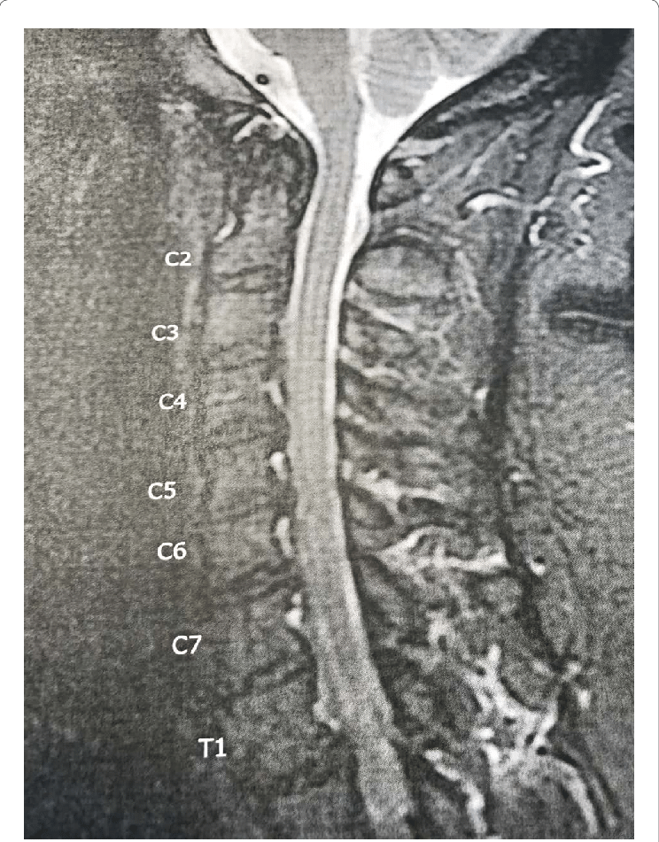 Multilevel Degenerative Disc Disease And Spondylosis Particularly At C5 6 Where There Is