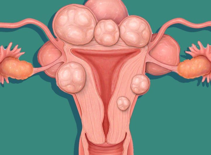 Uterine Fibroids 1510752893