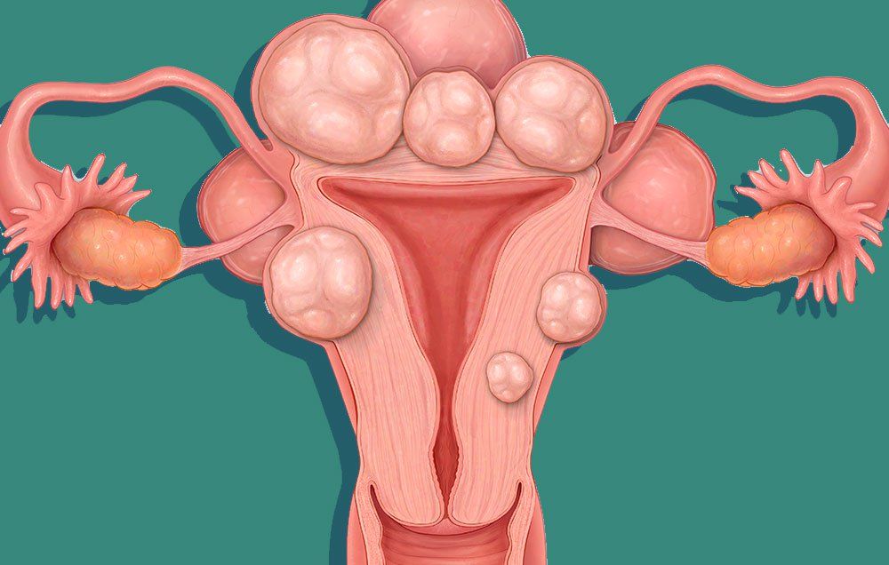 Uterine Fibroids 1510752893