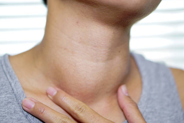 Asian Lady Woman Patient Have Abnormal Enlargement Of Thyroid Gland Hyperthyroidism At The (1)